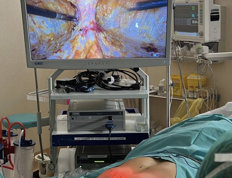 Operación de diástasis en el Hospital Vithas Valencia 9 de Octubre mediante la técnica pionera REPA